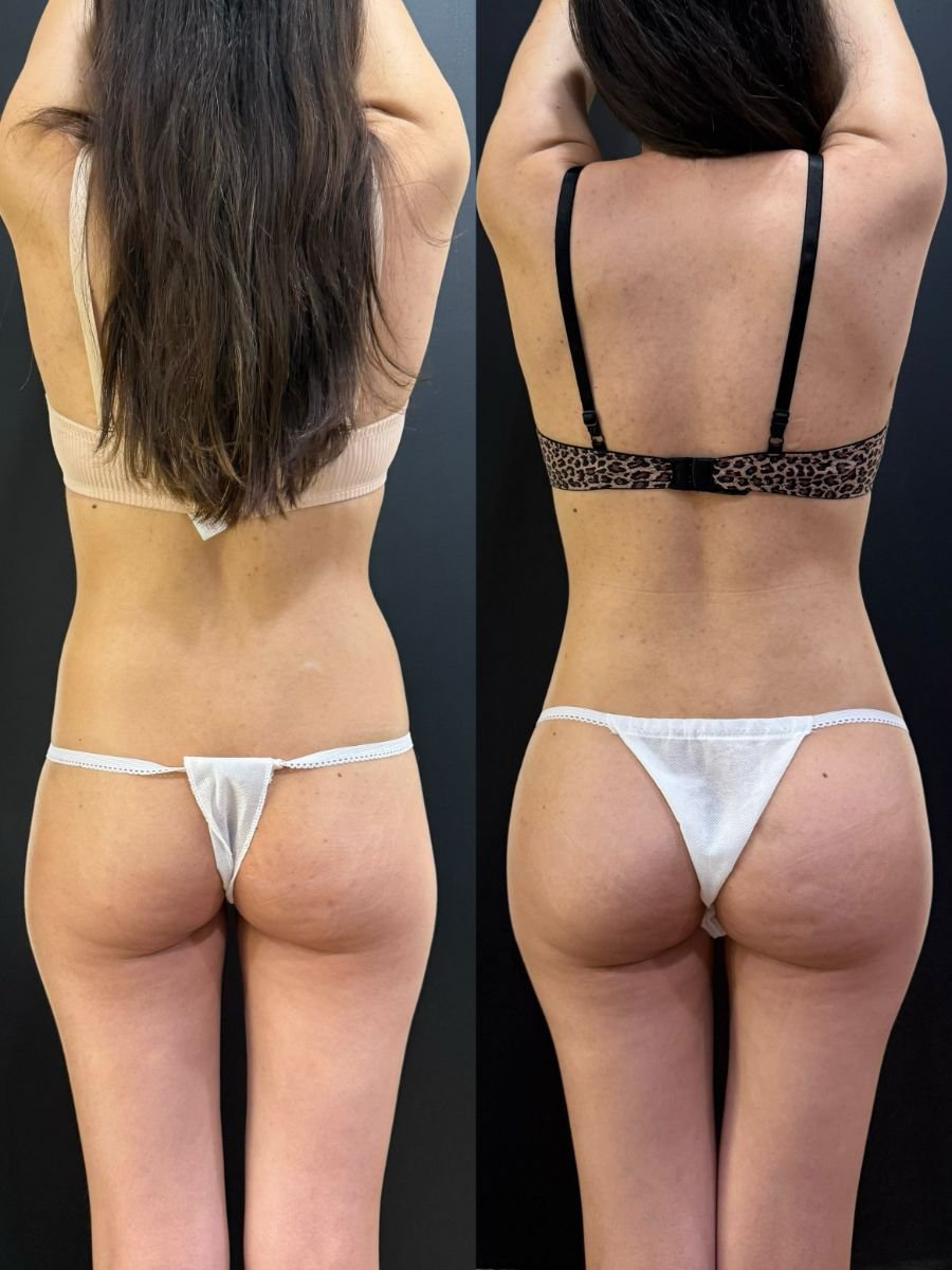 Resultados de liposucción antes y después en Dr. Alexandro Aguilera - Plastic Surgery, contorno corporal