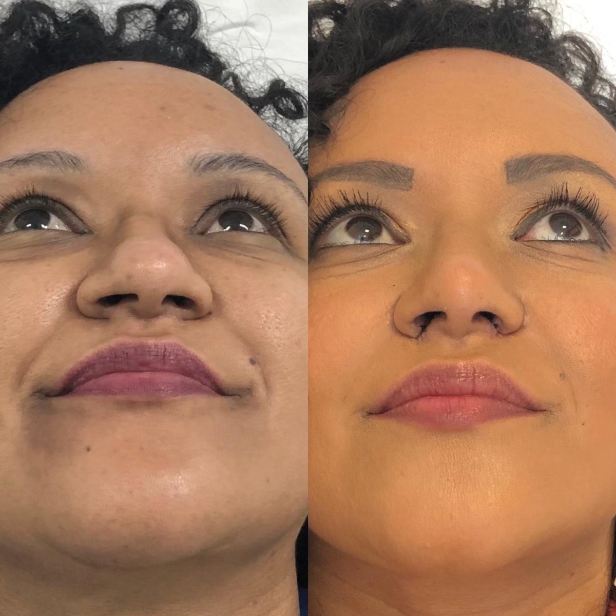 Résultats avant et après rhinoplastie chez Odontoliuzzi Dentistry and Health, remodelage du nez