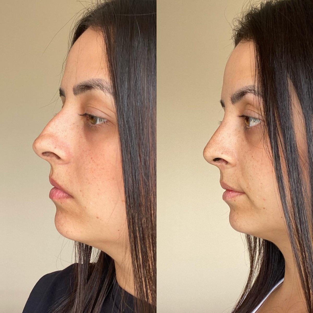 Результаты ринопластики до и после в Odontoliuzzi Dentistry and Health, коррекция носа