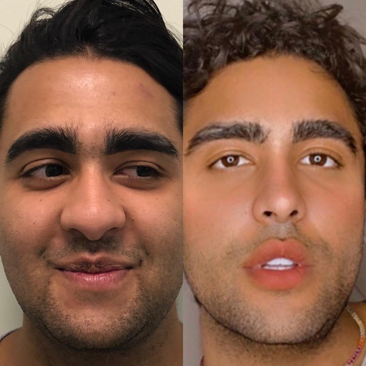 Resultados de rinoplastia antes y después en Odontoliuzzi Dentistry and Health, forma de nariz mejorada