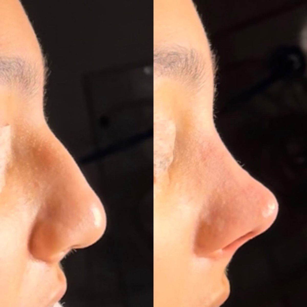 Resultados de rinoplastia antes y después en Odontoliuzzi Dentistry and Health, remodelación nasal