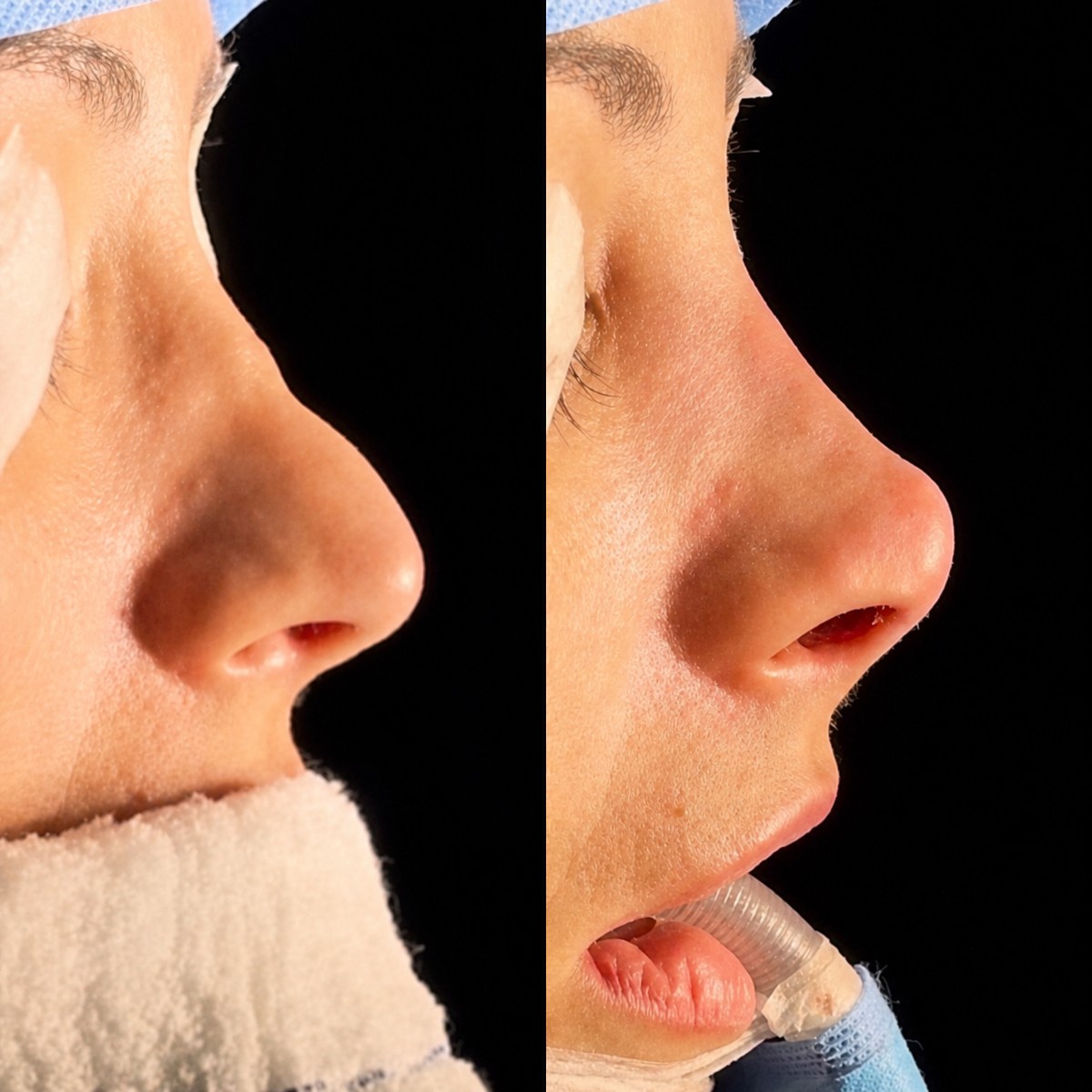 Resultados de rinoplastia antes y después en Odontoliuzzi Dentistry and Health, remodelación nasal