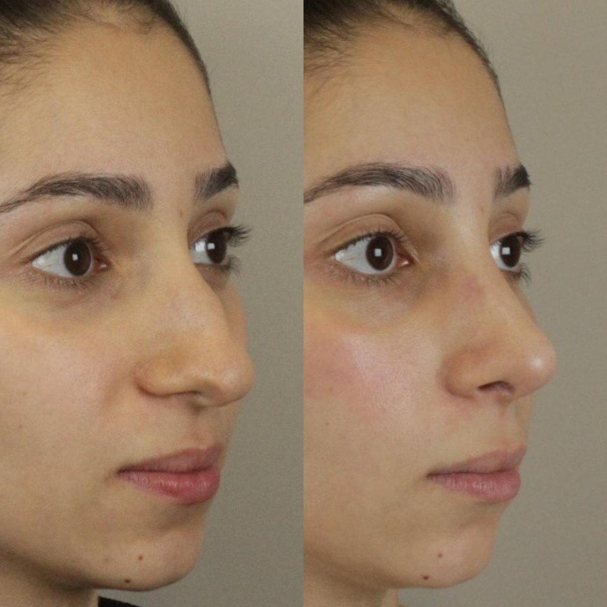 Résultats avant et après rhinoplastie chez Odontoliuzzi Dentistry and Health, remodelage du nez