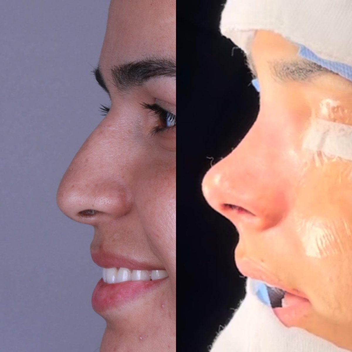 Resultados de rinoplastia antes y después en Odontoliuzzi Dentistry and Health, remodelación nasal