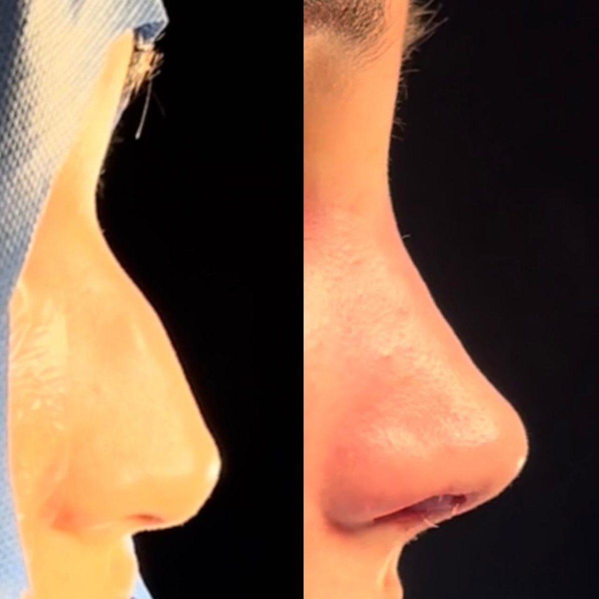 Resultados de rinoplastia antes y después en Odontoliuzzi Dentistry and Health, remodelación nasal