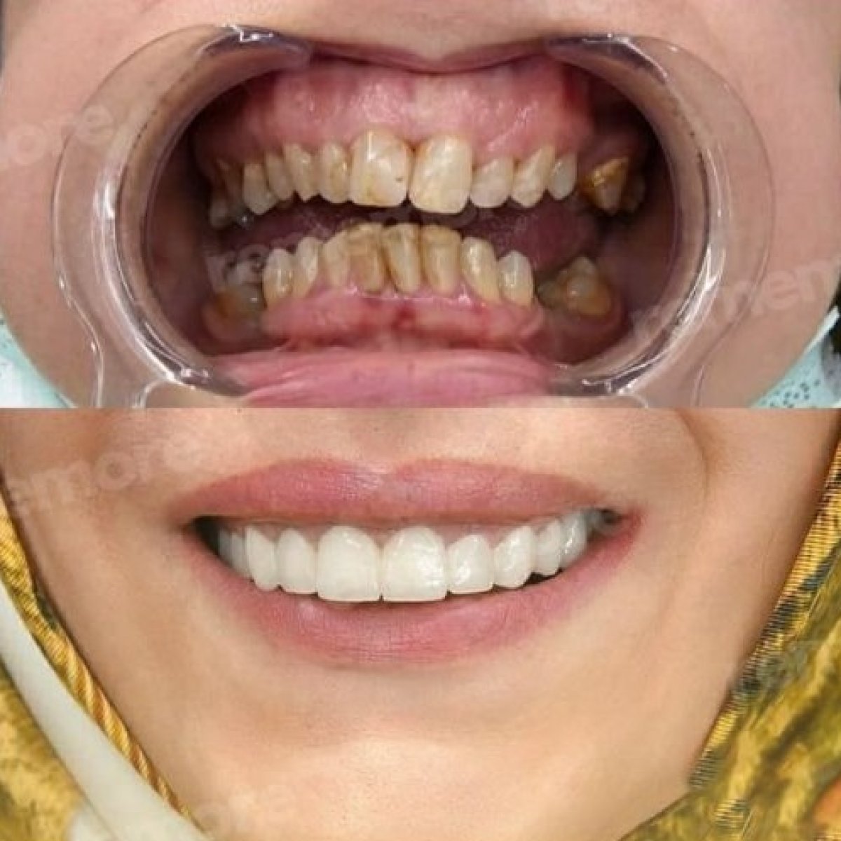 Antes y después de carillas dentales en Memorial Bahçelievler Hospital – resultado sonrisa