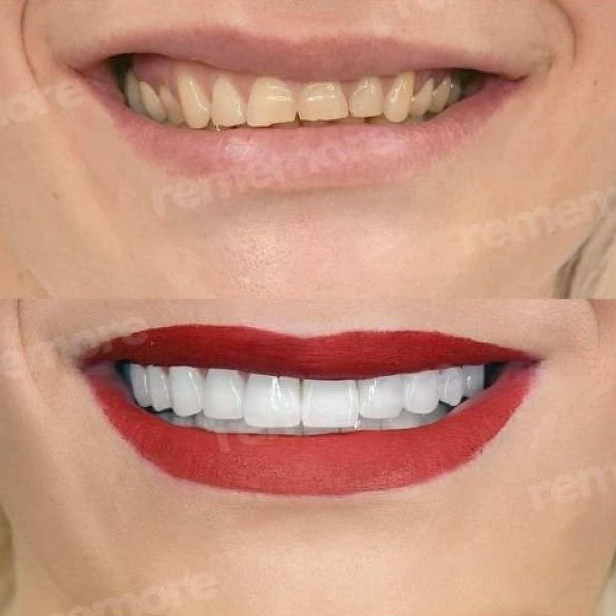 Antes y después de carillas en Memorial Bahçelievler Hospital – resultados de sonrisa
