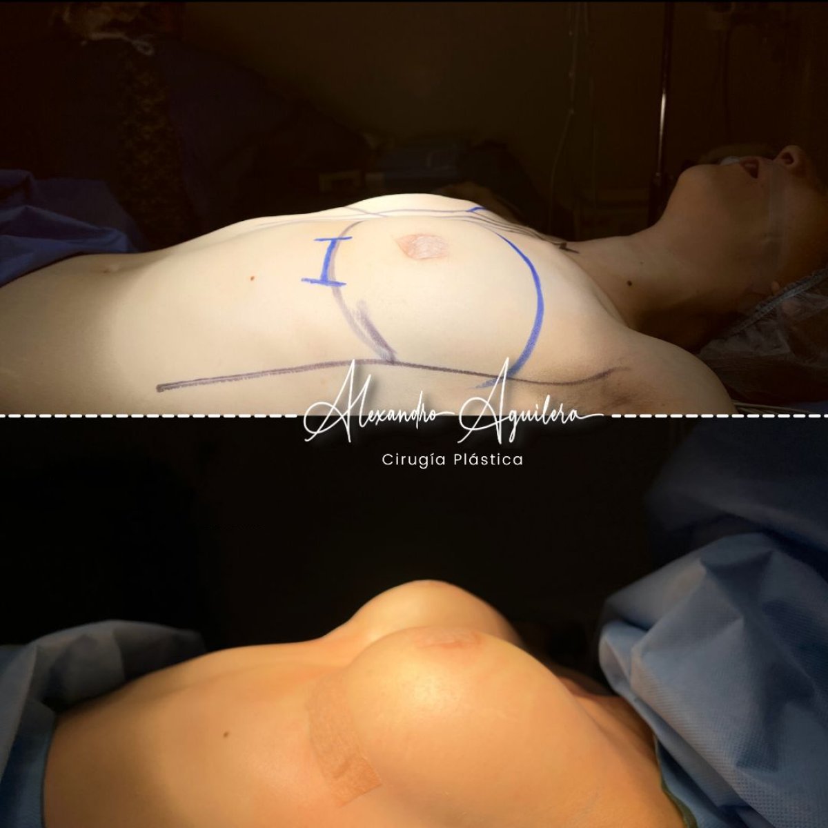 نتائج تكبير الثدي قبل وبعد في عيادة د. أليخاندرو أغيليرا لجراحة التجميل