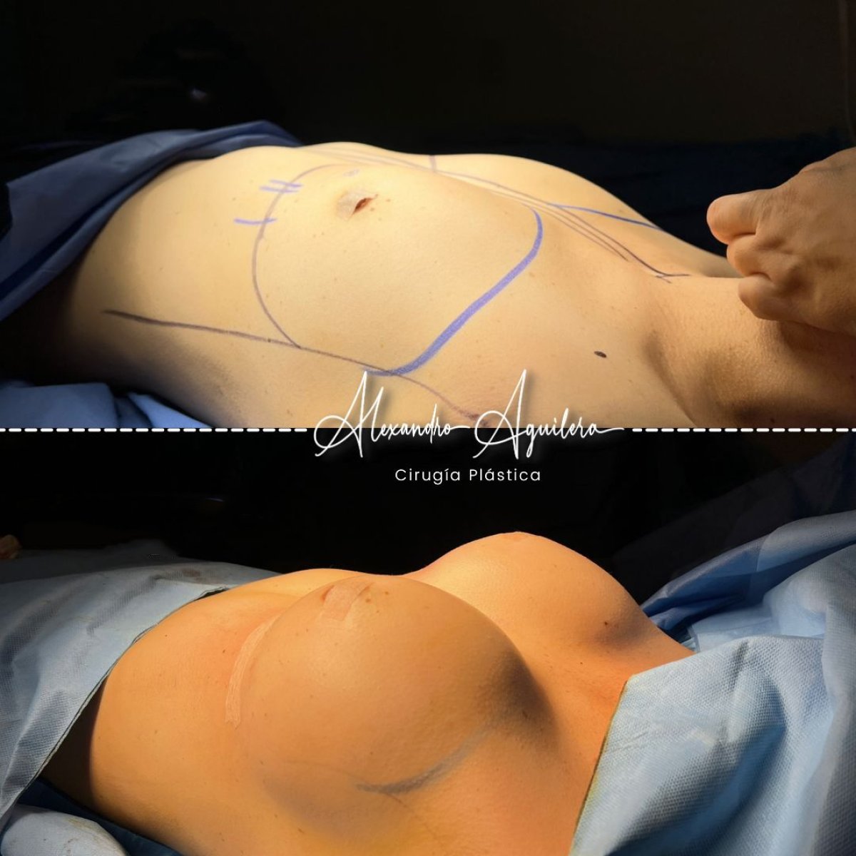 نتائج تكبير الثدي قبل وبعد في عيادة Dr. Alexandro Aguilera - Plastic Surgery
