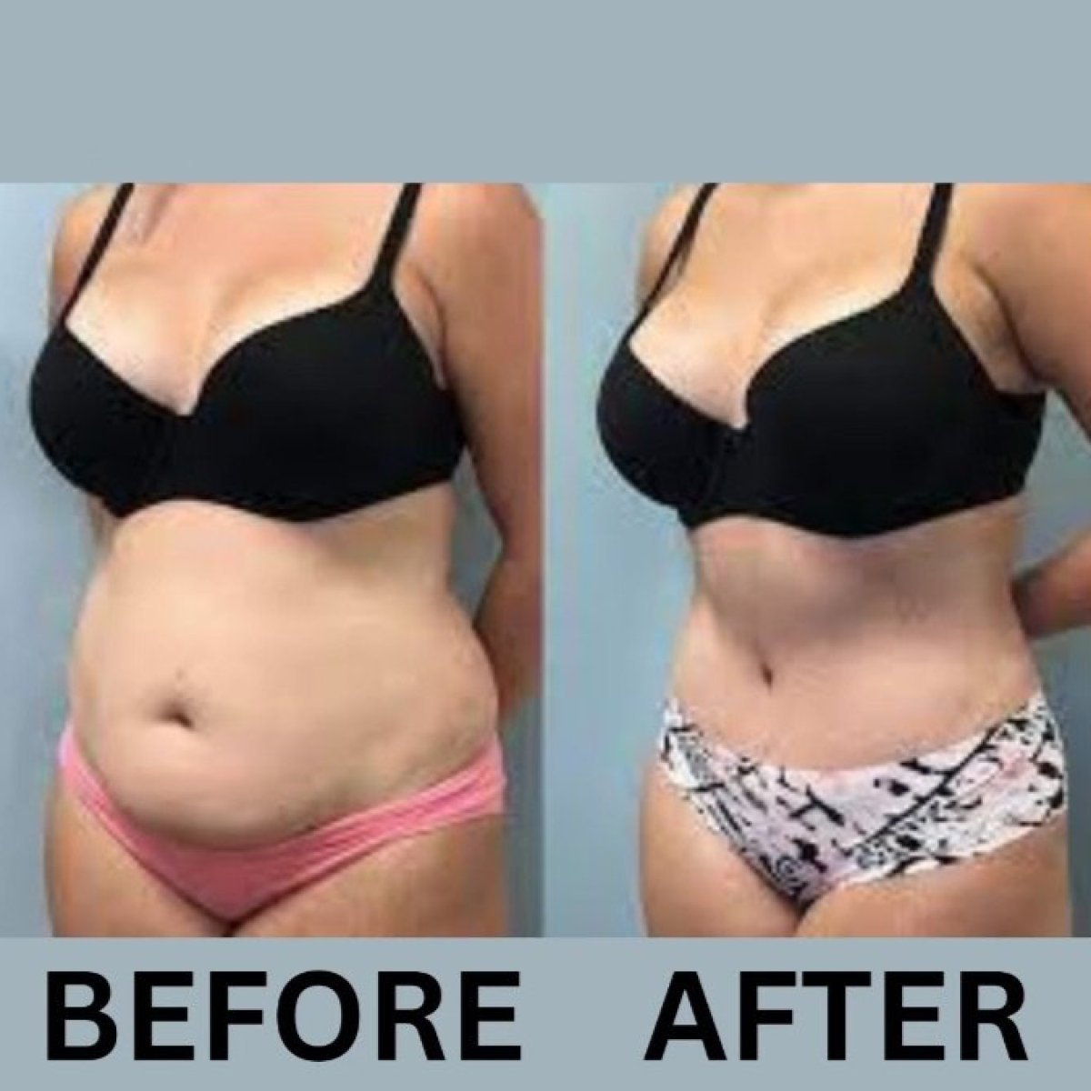 Before and after mommy makeover results at ID Clinic Bangkok, visible body contour improvement