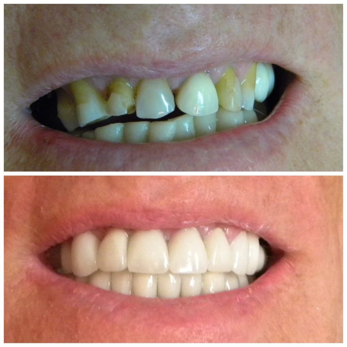 Before and after veneers at SoftDentalCare Clinic – smile makeover with natural-looking results