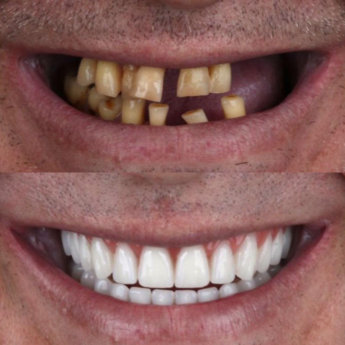 Antes y después de la instalación de dentaduras completas en European Valley Health, resultado de sonrisa