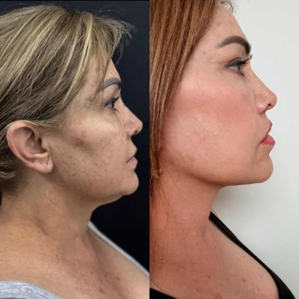 Facelift Vorher-Nachher-Ergebnisse bei Marroquín & Sandoval Plastic Surgery Clinic, Gesichtsverjüngung