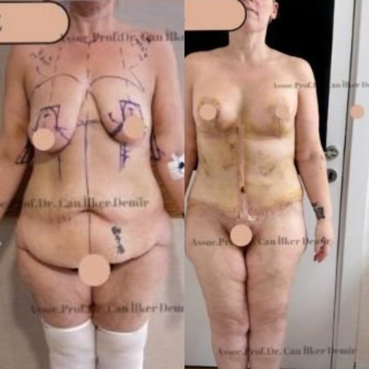 Before and after full body lift results at Memorial Şişli Hospital, body contour improvement