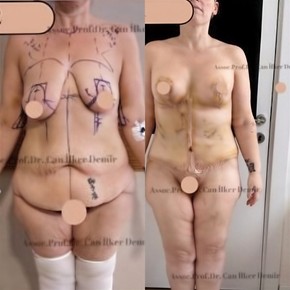 360° Full Body Lift for Total Body Contouring — 7 Nights at 5★ Hotel - photo 6