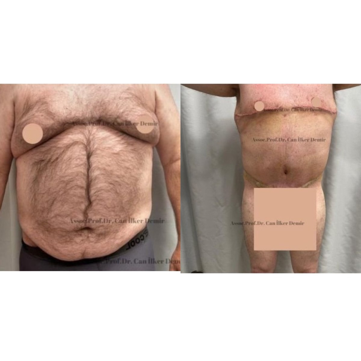 Full body lift before and after results at Memorial Şişli Hospital, improved body contour