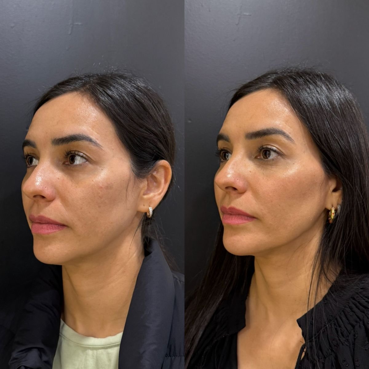 Resultado antes y después de rellenos en Dr. Alexandro Aguilera - Plastic Surgery, contorno facial