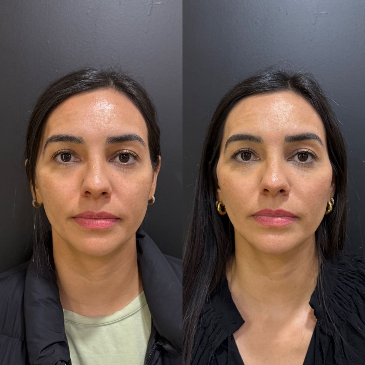 نتائج قبل وبعد حقن الفيلر في Dr. Alexandro Aguilera - Plastic Surgery، تجديد شباب الوجه