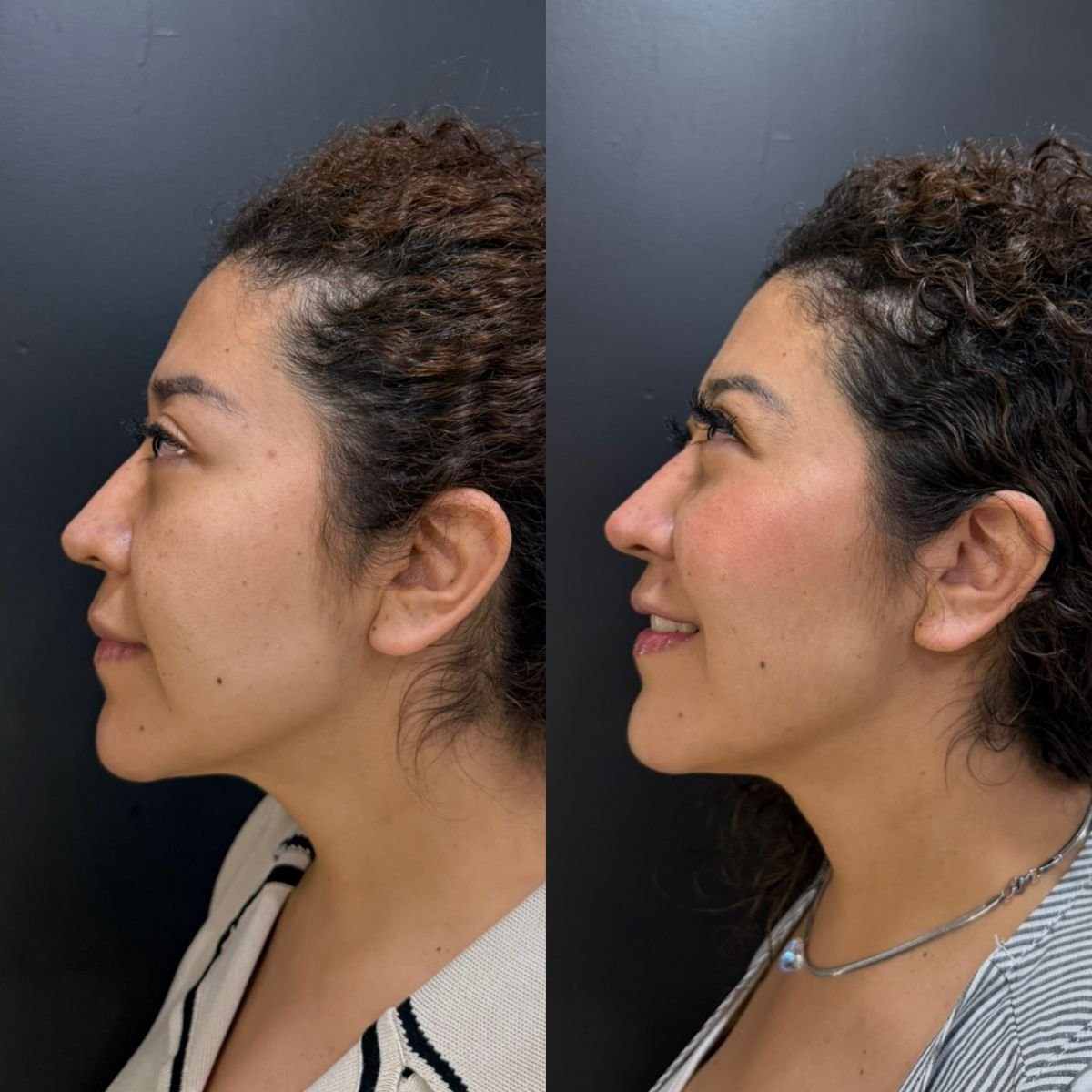 Resultado antes y después de rellenos en Dr. Alexandro Aguilera - contorno facial