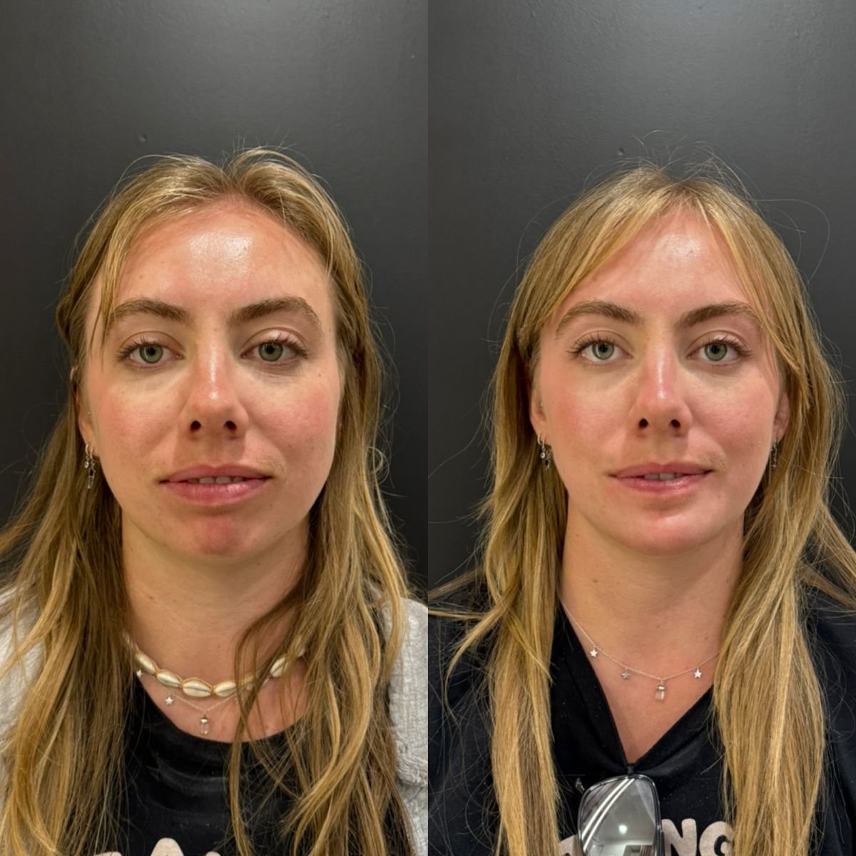 Before and after chin implant results at Dr. Alexandro Aguilera - Plastic Surgery clinic