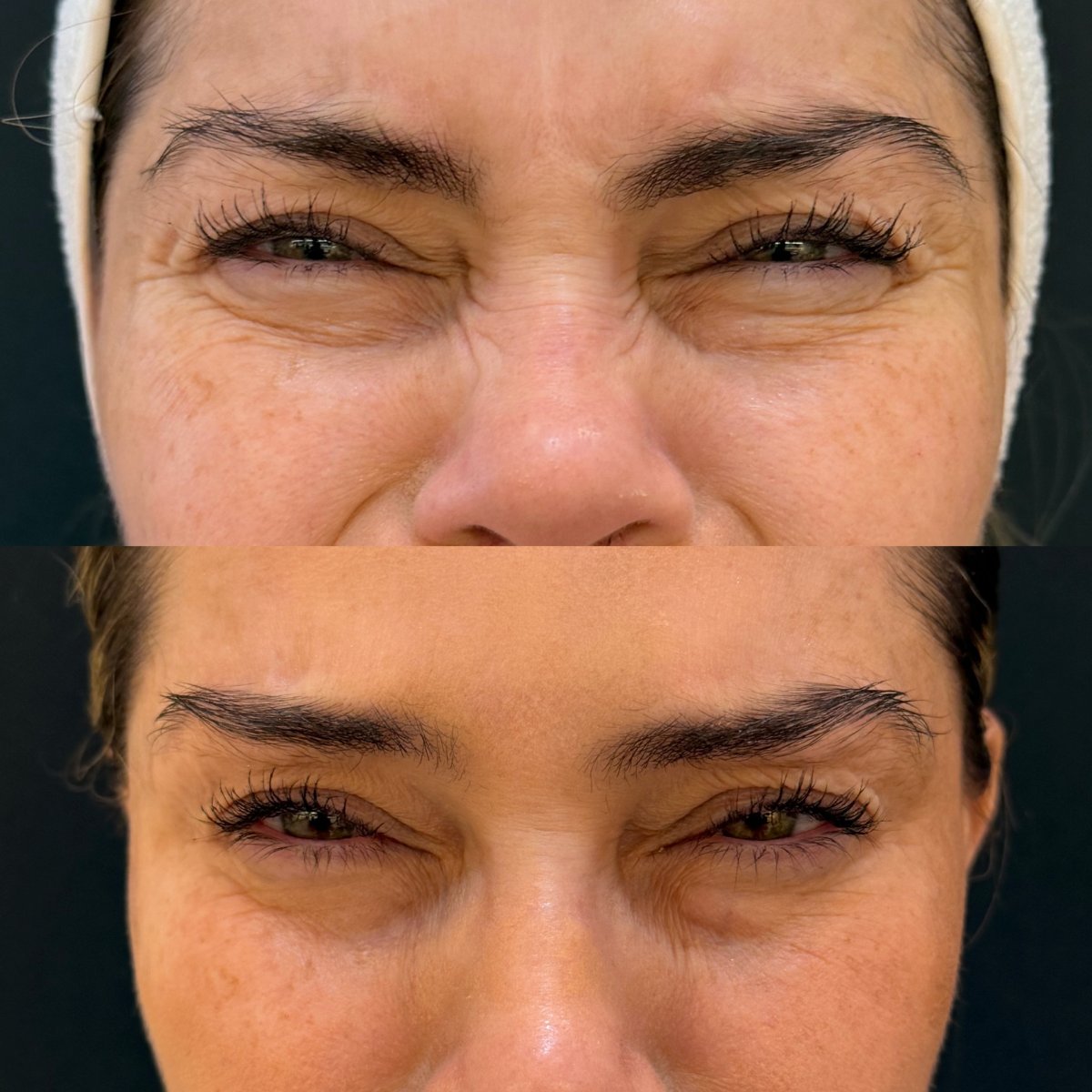Resultados antes y después de inyecciones de Botox: menos arrugas y piel más lisa