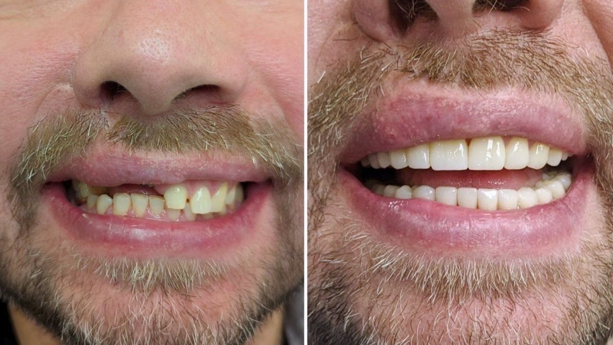 Результаты до и после Hollywood Smile в Smile Centrum – заметное преображение улыбки