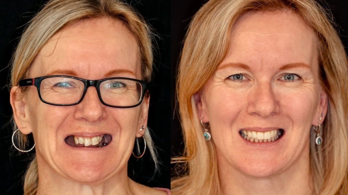 نتائج قبل وبعد ابتسامة هوليود في Smile Centrum – استعادة الابتسامة بالعدسات