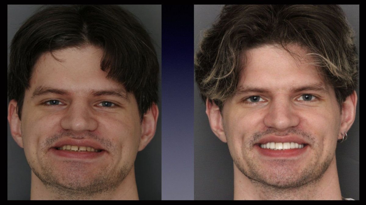Résultats avant et après Hollywood Smile chez Smile Centrum – transformation visible du sourire