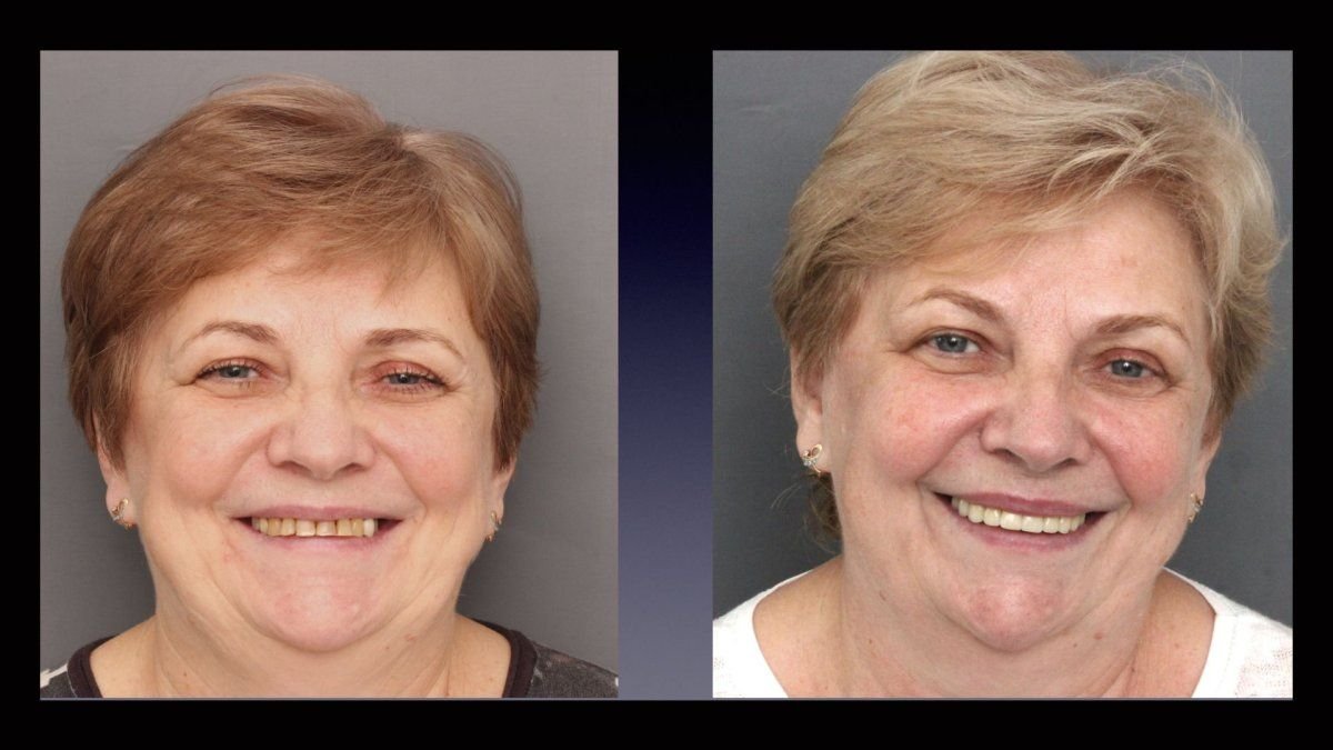 نتائج قبل وبعد ابتسامة هوليوود في Smile Centrum، تحول واضح في الأسنان