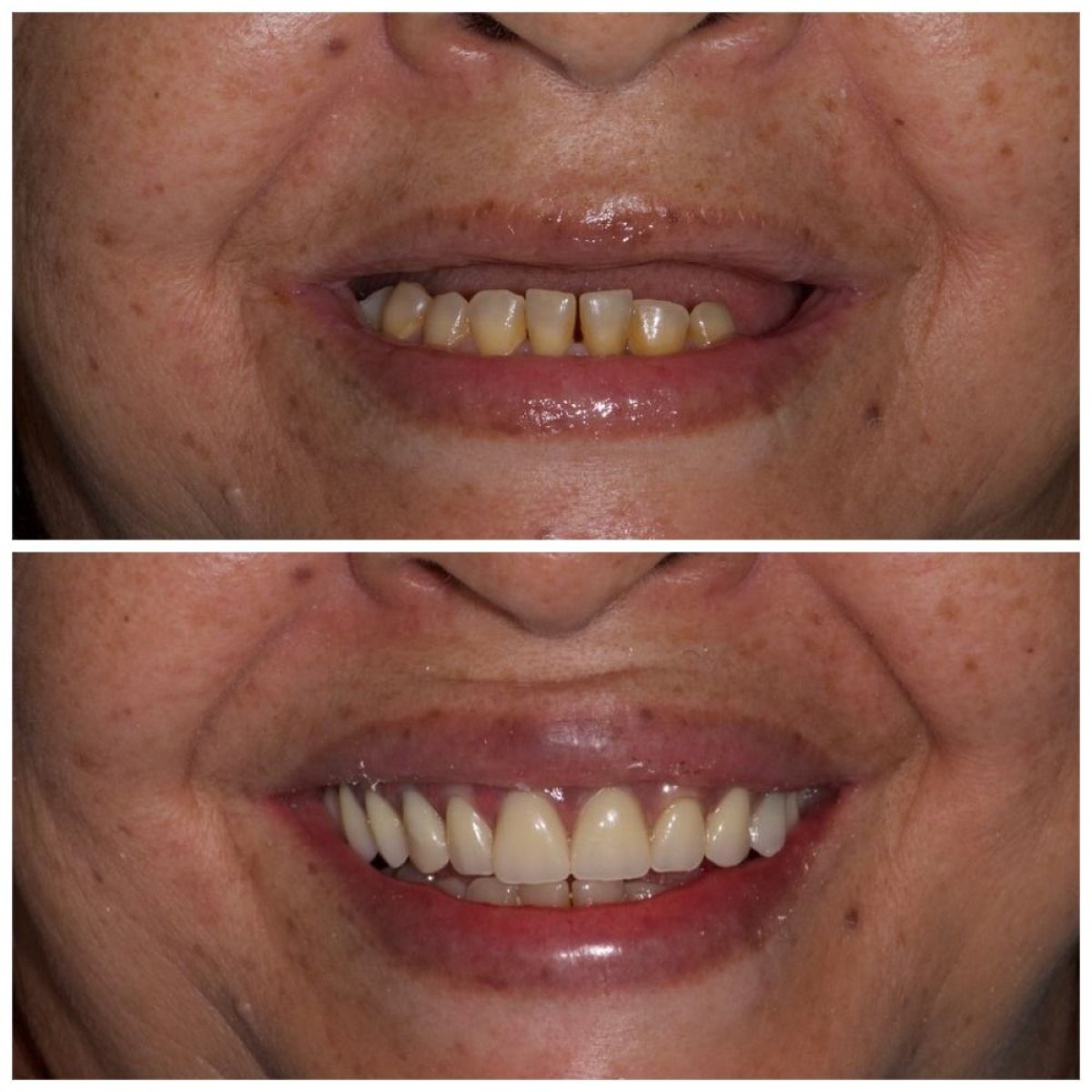 Efekt przed i po implantach All-on-6 w Clinica Dental Pujols Rodriguez, uśmiech przywrócony