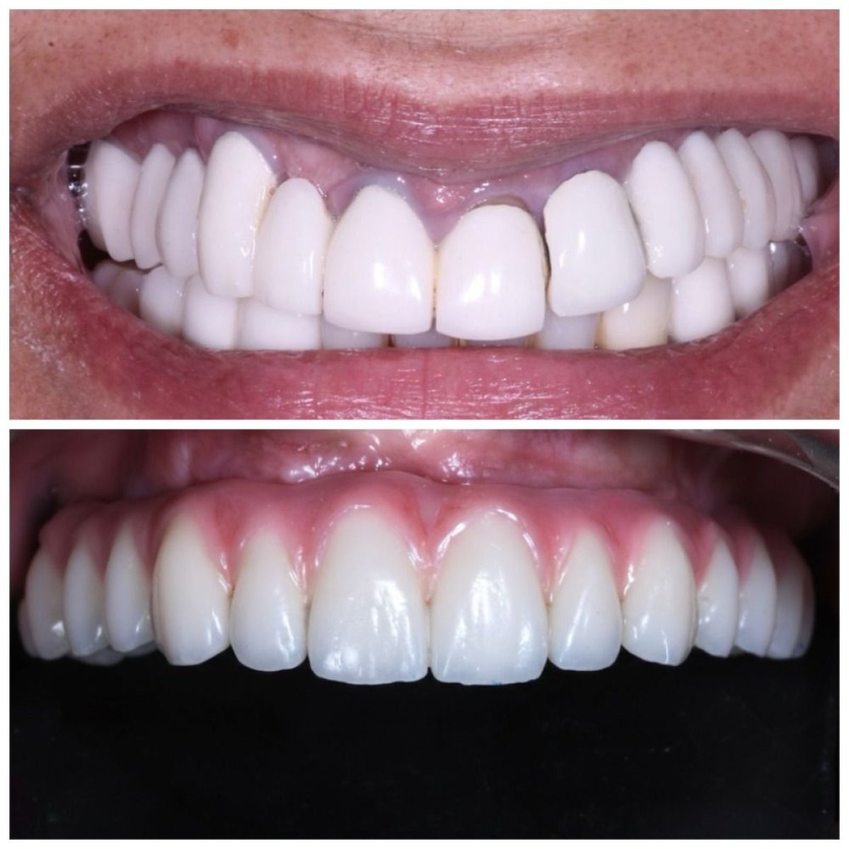 Resultados antes y después de implantes All-on-6 en Clinica Dental Pujols Rodriguez, restauración de sonrisa