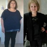 Before and after Gastric balloon photos by Dr. Carlos Ballesta Lopez