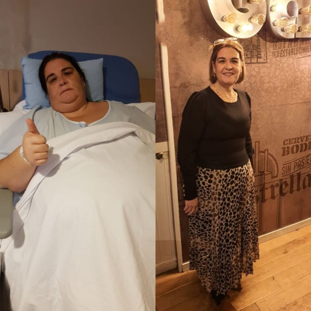 Before and after gastric band results at Centro Médico Teknon – significant weight loss shown