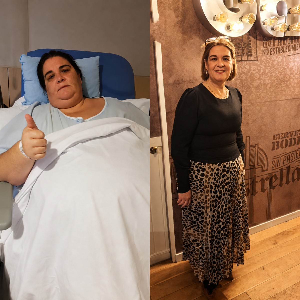 Before and after gastric bypass at Centro Médico Teknon, significant weight loss result
