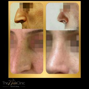 Septoplasty by European Rhinoplasty Society Member with 5,000+ Procedures — Transfers Included - photo 4