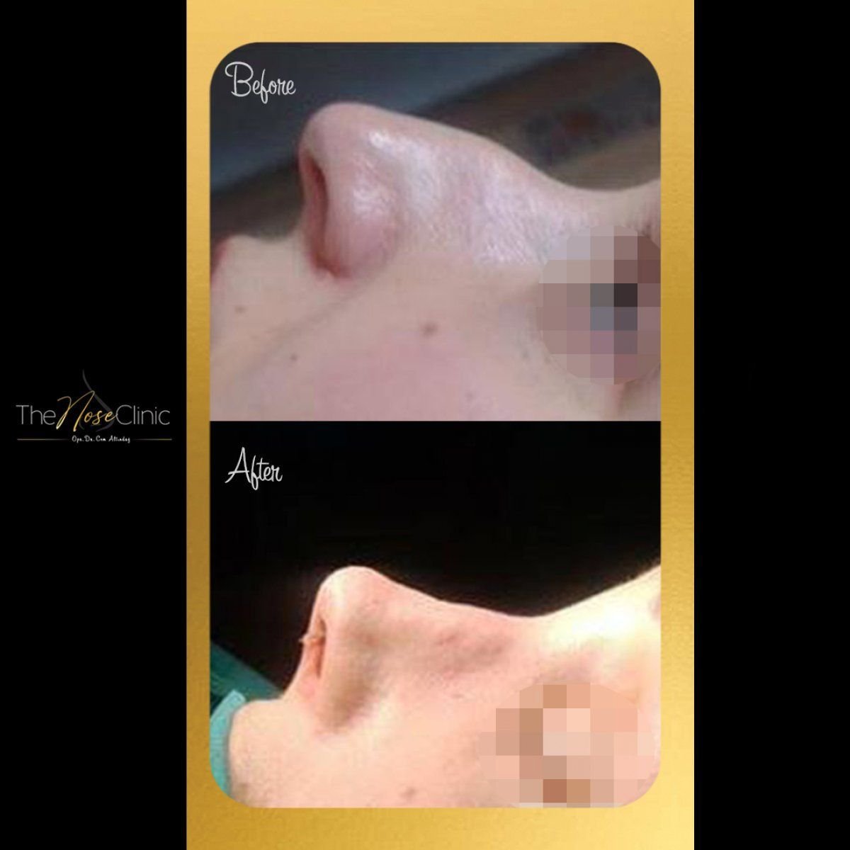 Resultados de septoplastia antes y después en The Nose Clinic, perfil nasal mejorado