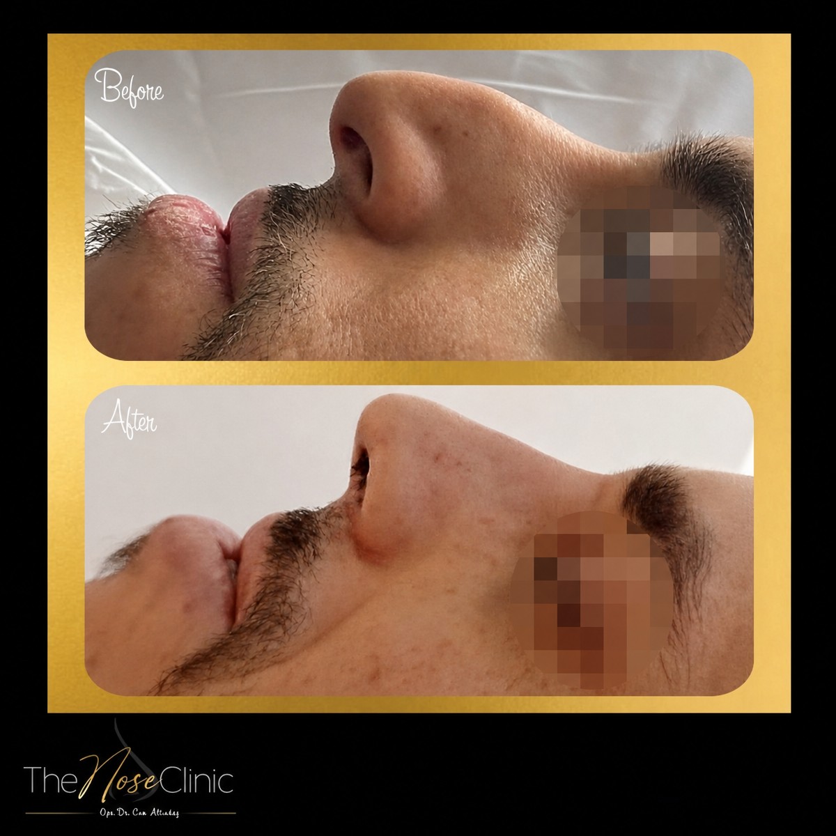 Resultados antes y después de septoplastia en The Nose Clinic, mejor perfil nasal y respiración