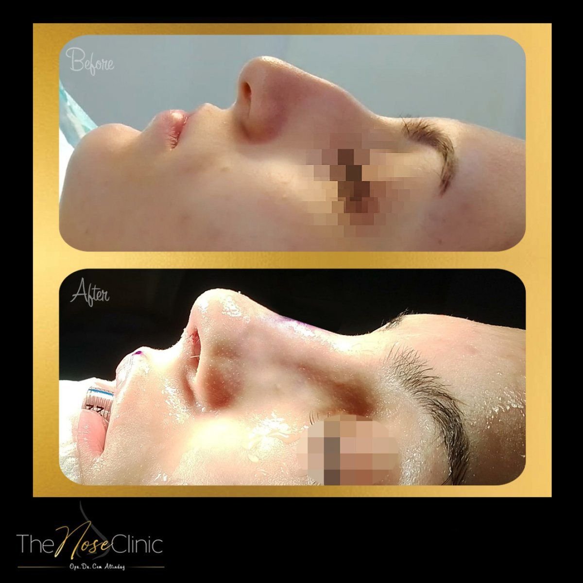 Resultados antes y después de septoplastia en The Nose Clinic, perfil nasal mejorado