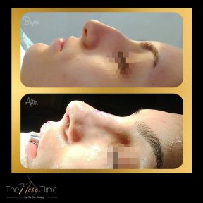 Septoplasty by European Rhinoplasty Society Member with 5,000+ Procedures — Transfers Included - photo 5
