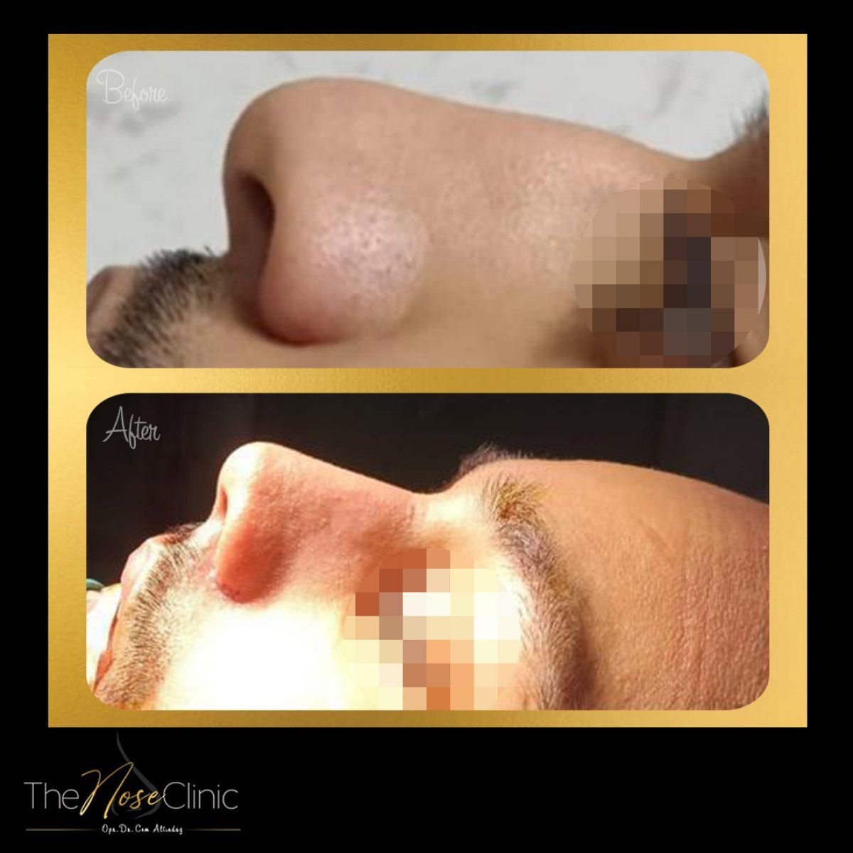 Resultados antes y después de septoplastia en The Nose Clinic para corregir tabique desviado