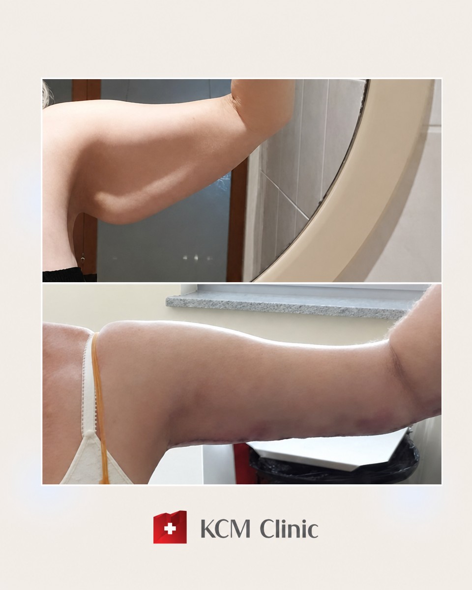 Resultados antes y después de lifting de brazos (braquioplastia) en KCM Clinic – mejor contorno