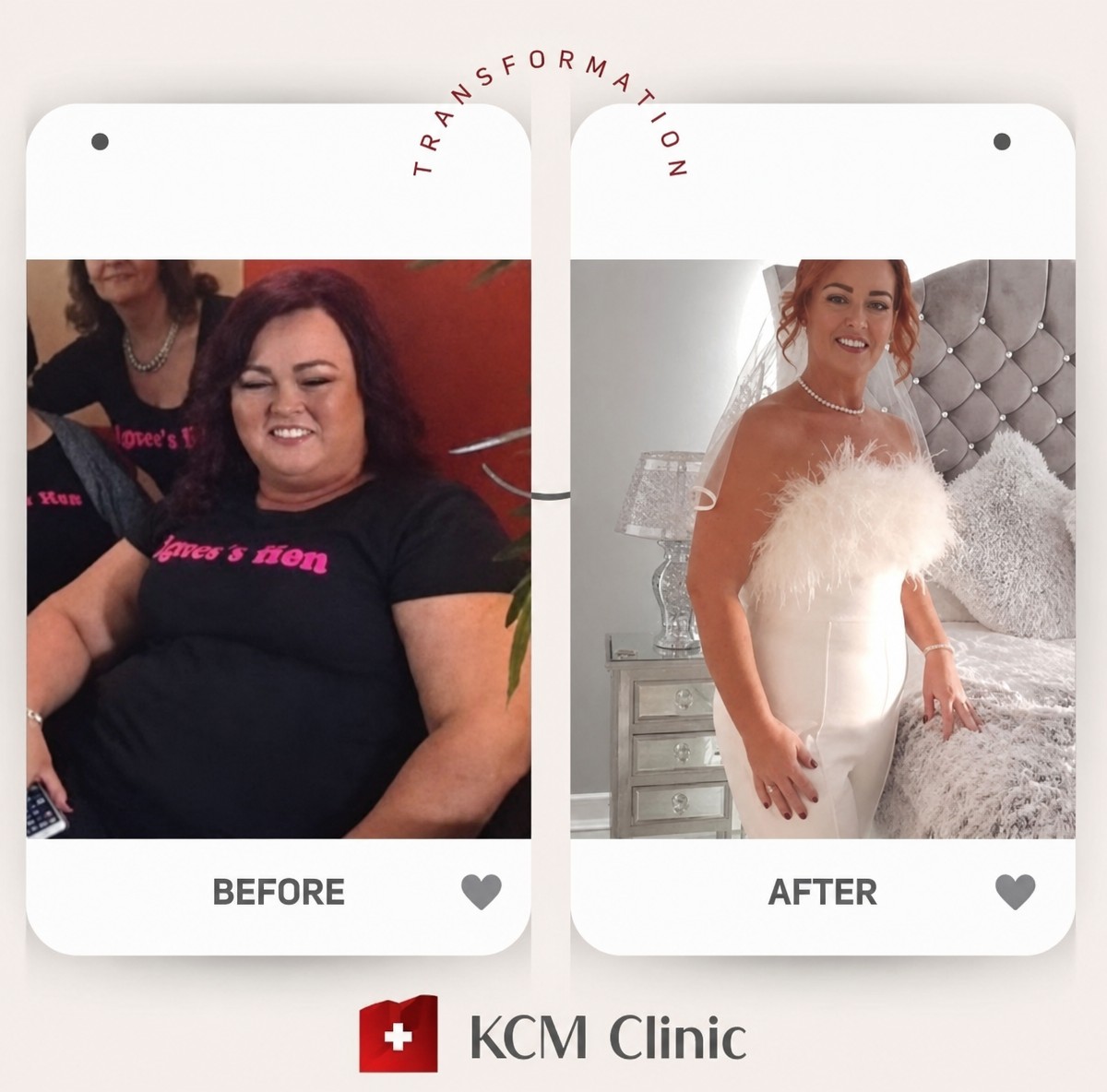 Before and after gastric balloon results at KCM Clinic – significant weight loss transformation