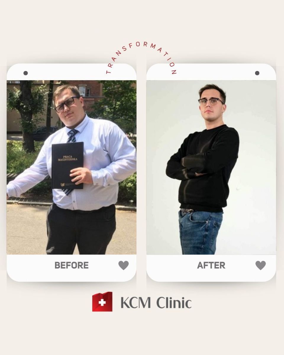 Before and after gastric balloon results at KCM Clinic – visible weight loss transformation