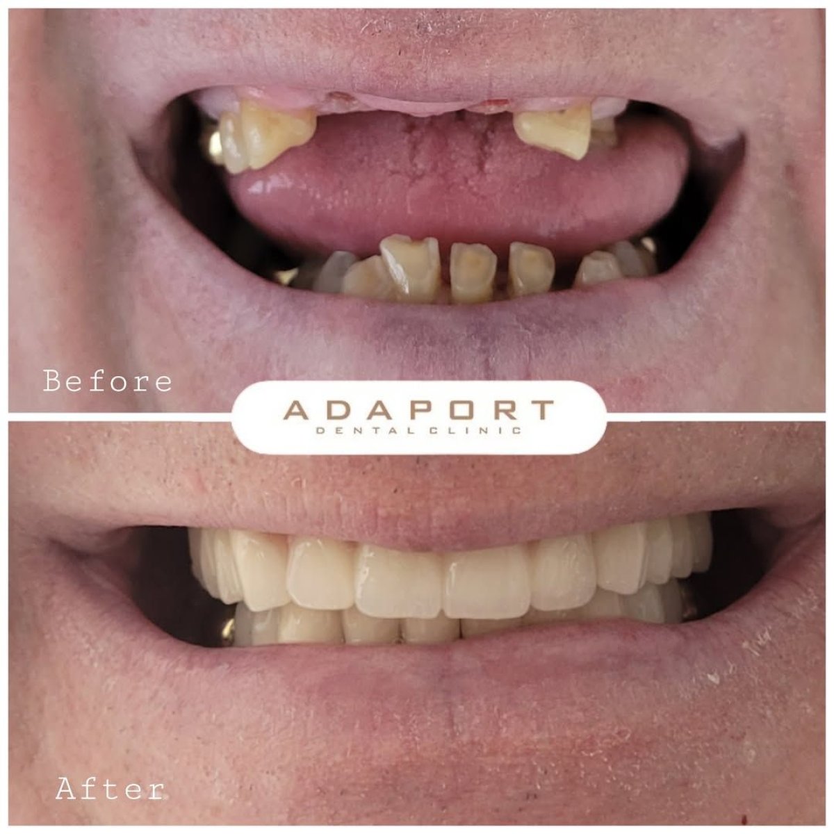 Resultado antes y después de implantes All-on-4 en Adaport Dental Clinic, restauración de sonrisa