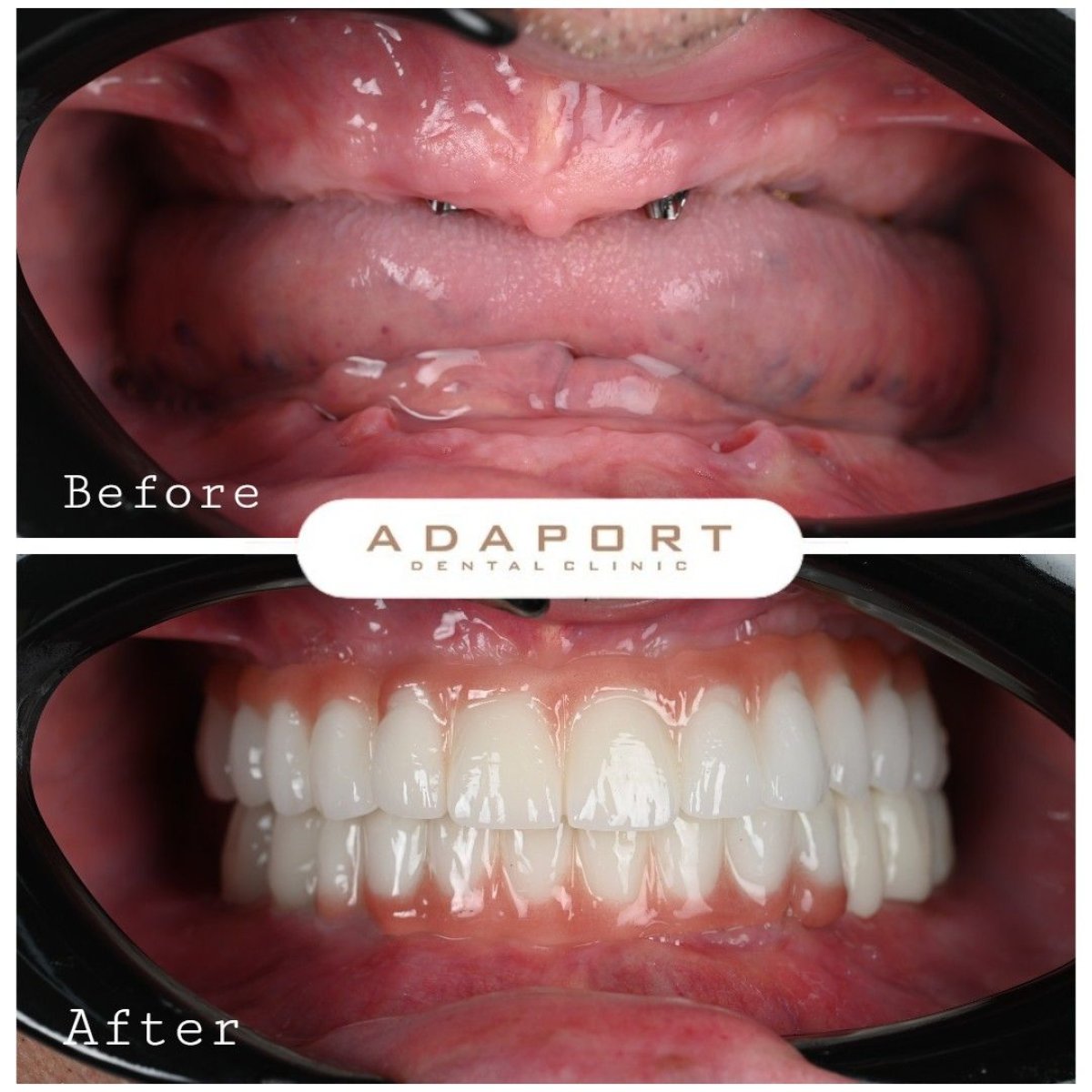 Resultado antes y después de implantes dentales All-on-4 en Adaport Dental Clinic, sonrisa completa