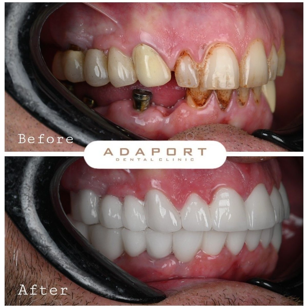 All-on-4 dental implants before and after result at Adaport Dental Clinic, smile restoration