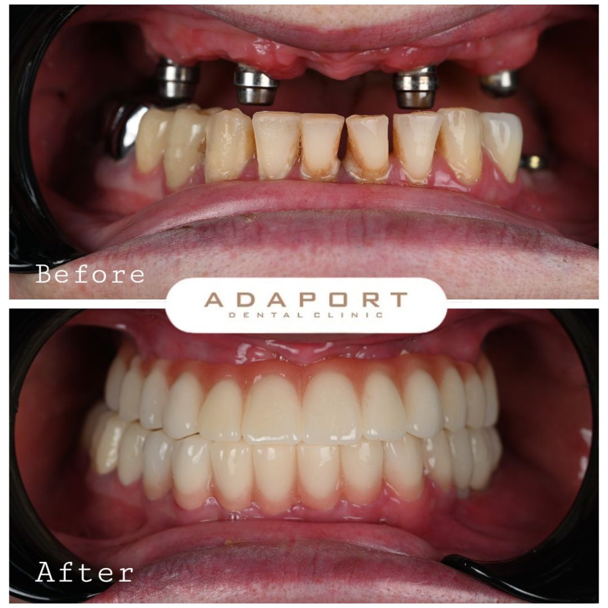 Before and after All-on-4 dental implants result at Adaport Dental Clinic, smile restoration