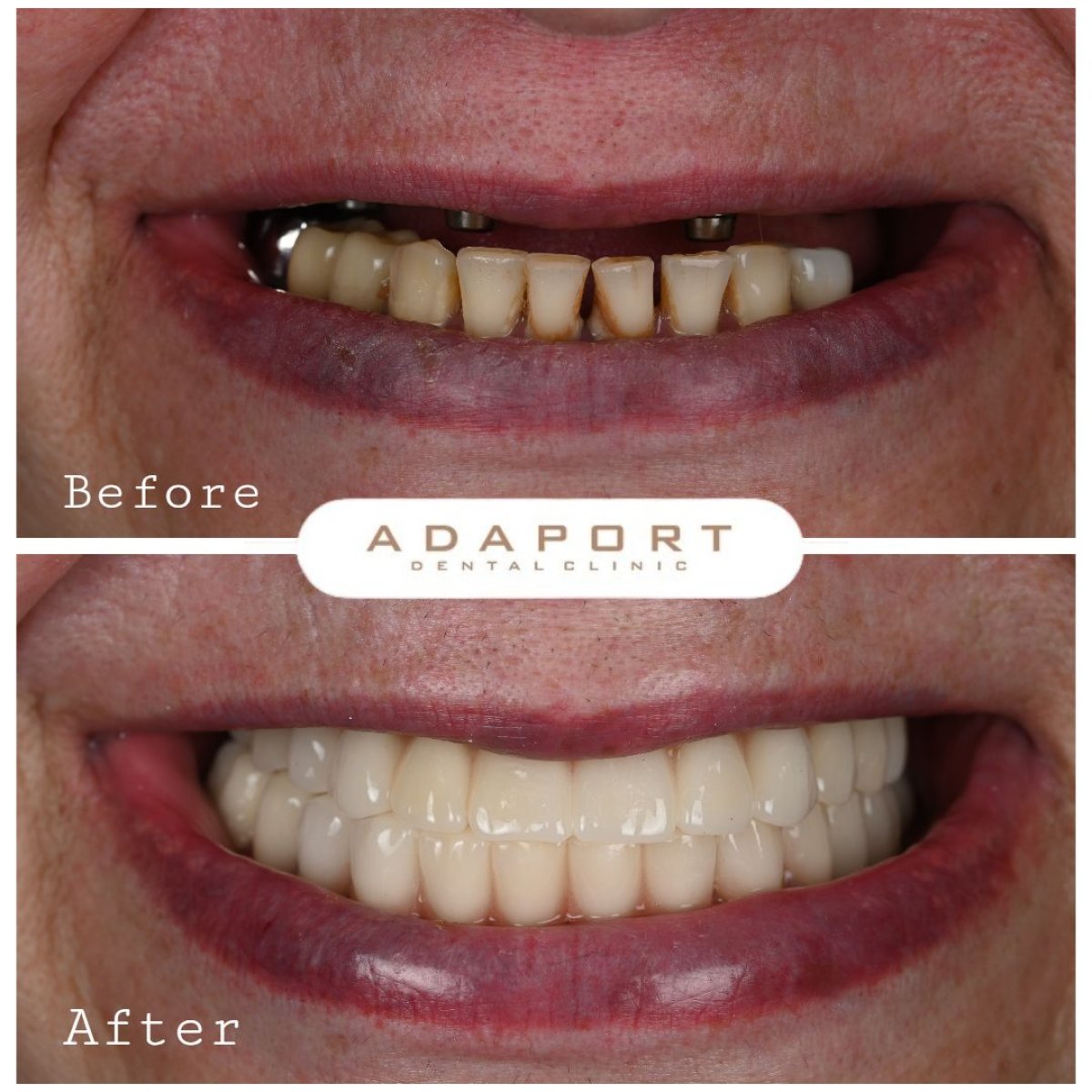 Resultado antes y después de implantes All-on-4 en Adaport Dental Clinic, restauración de sonrisa