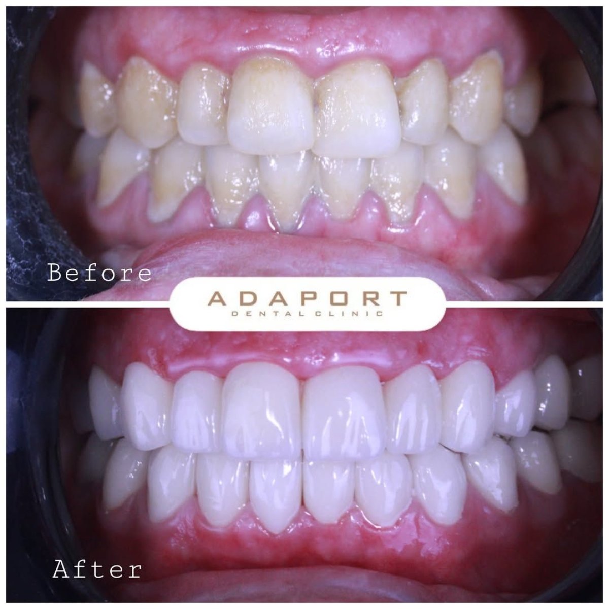 До и после установки виниров Emax в Adaport Dental Clinic – результат преображения улыбки