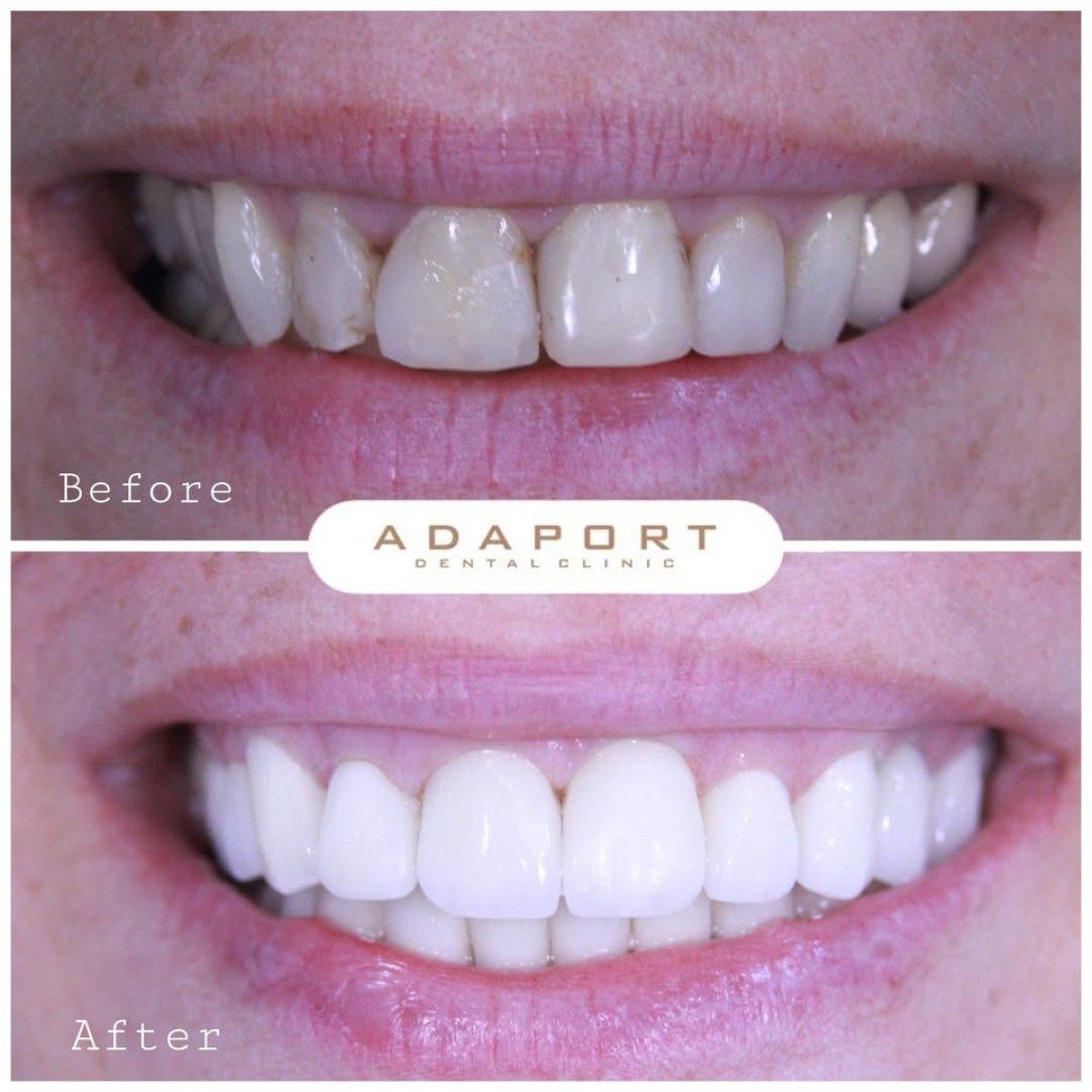 Результат до и после установки виниров Emax в Adaport Dental Clinic – преображение улыбки
